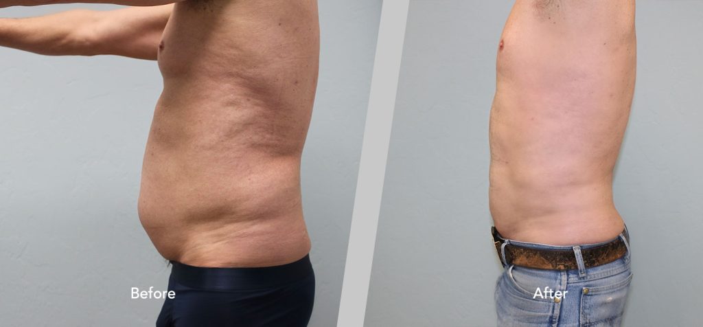 Before and After Gallery: Gynecomastia B Banner