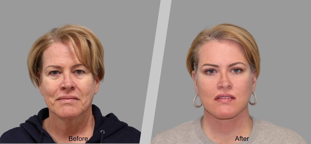 Before and After Gallery: Facelift banner