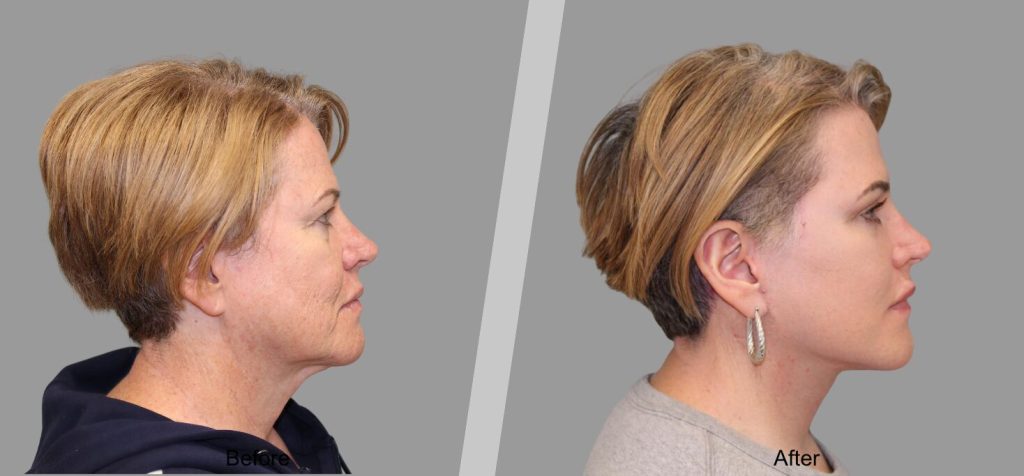 Before and After Gallery: Facelift banner