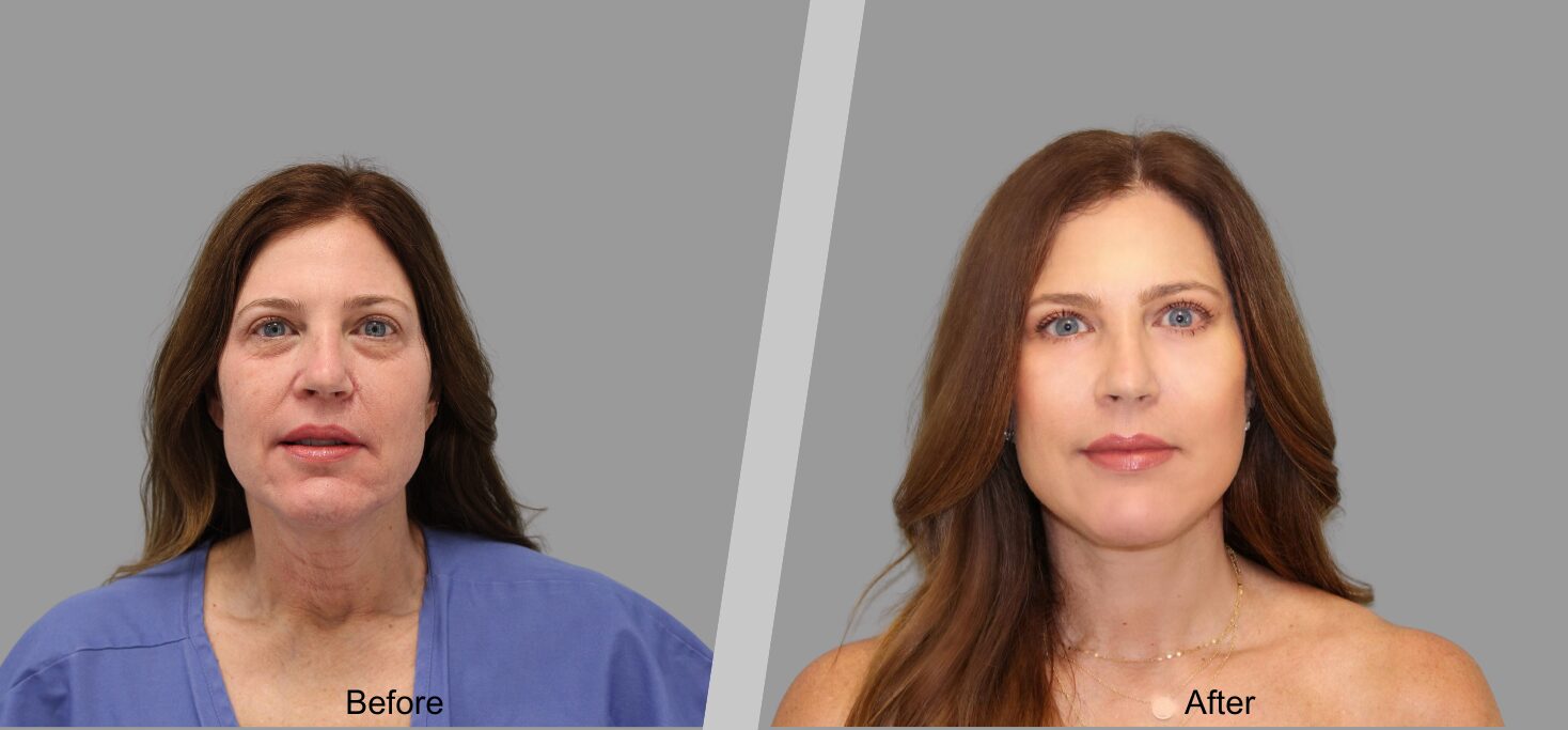 Before and After Gallery: Facelift banner