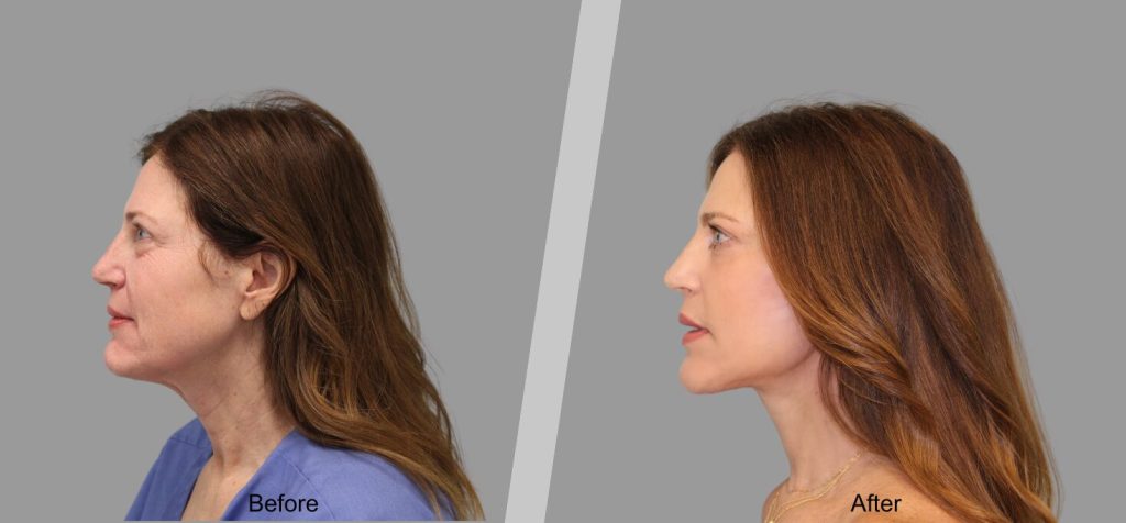 Before and After Gallery: Facelift banner