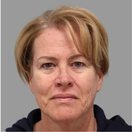 Facelift – Case 5 Before & After Banner