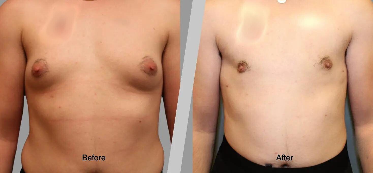 Before and After Gallery: Gynecomastia C Banner
