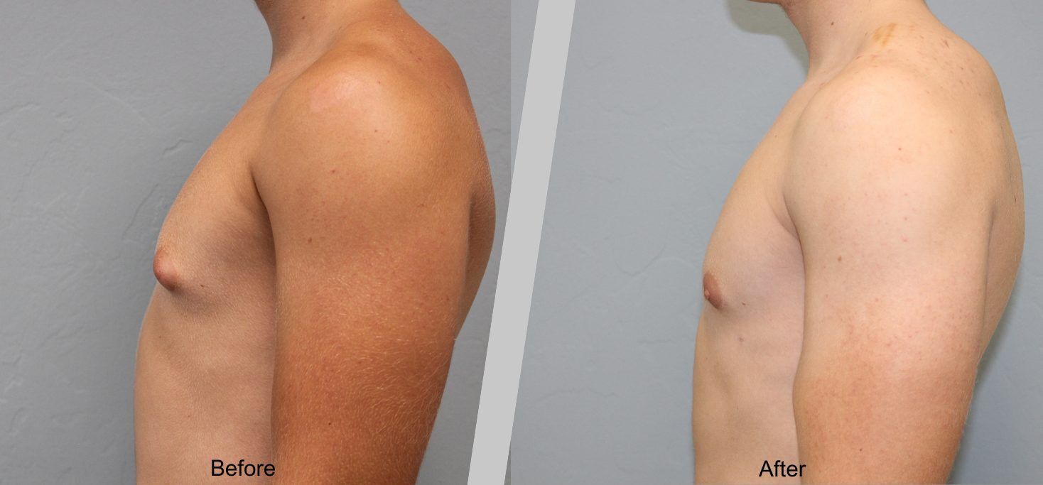 Before and After Gallery: Gynecomastia D Banner