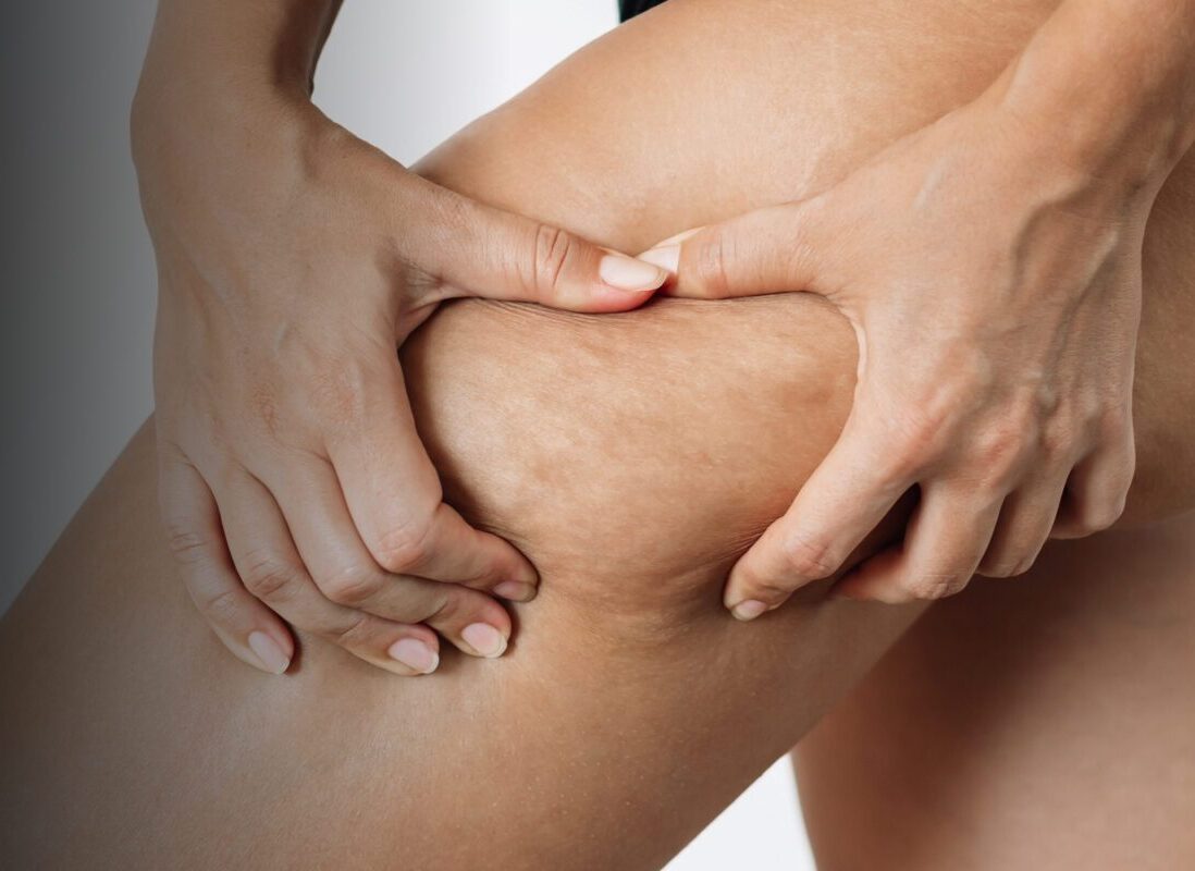 Aveli Cellulite Treatment in Tucson, AZ Banner