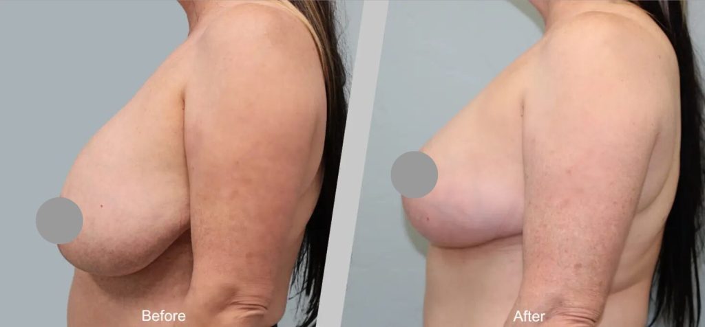 Before and After Gallery: Breast Lift