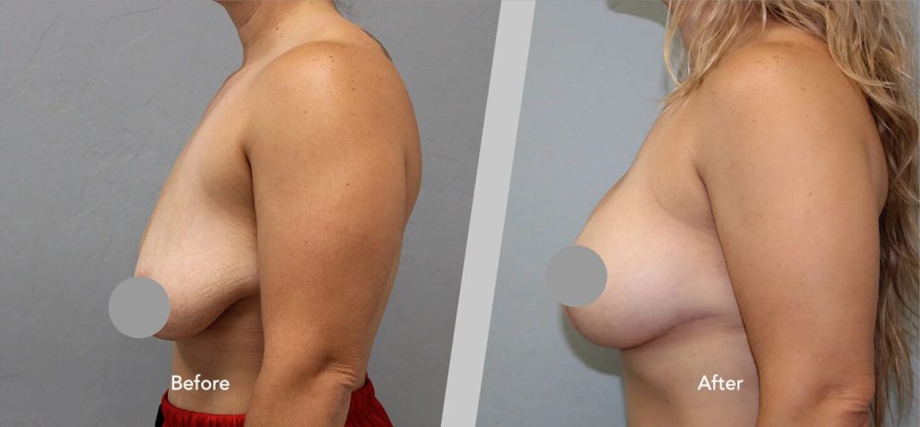 Before and After Gallery: Breast Lift