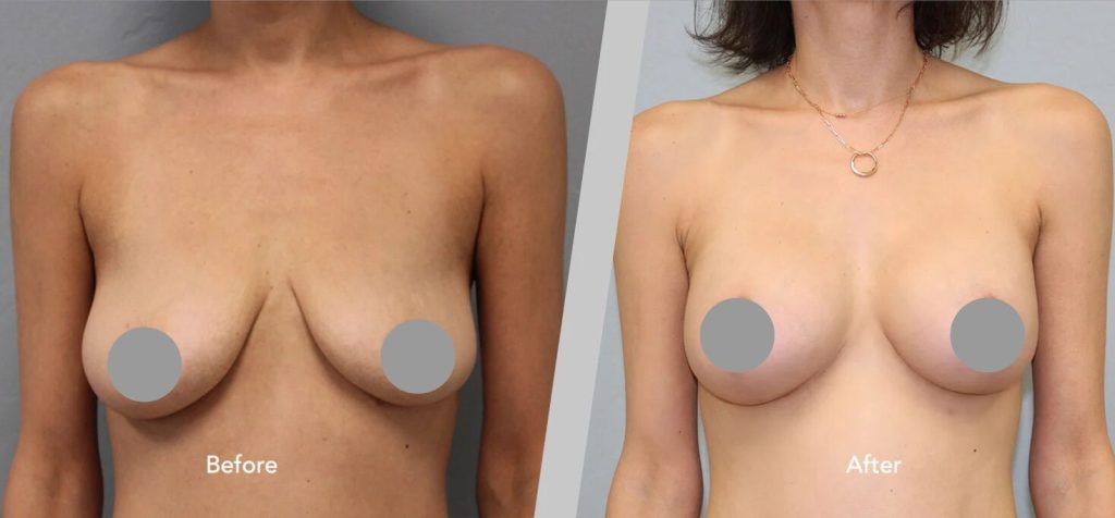 Before and After Gallery: Breast Lift